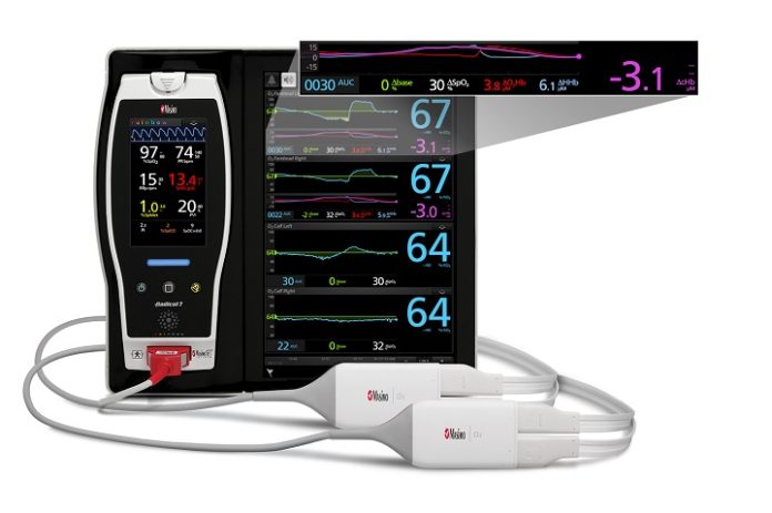 Masimo Announces the Limited Market Release of Visual Clinical Activity Monitoring 
