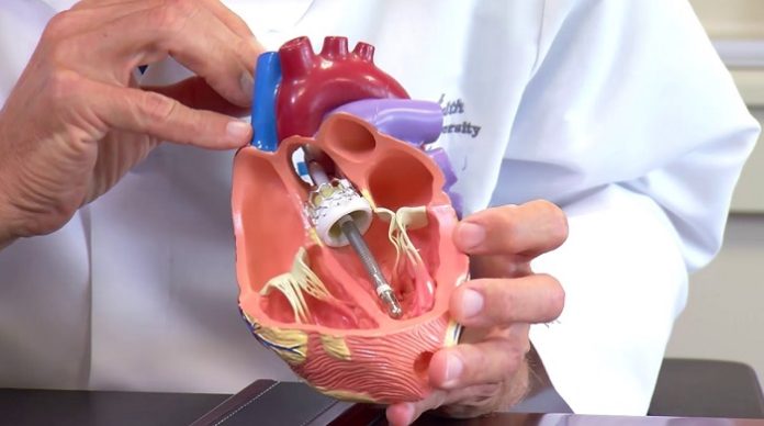 First Patients Treated in the US with the Worlds Smallest Heart Pump