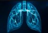 AstraZeneca and Institut Kanser Negara Partner for AI Lung Screening