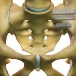 Novel Spinopelvic Fixation Technology