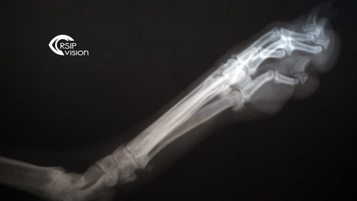 RSIP Vision Announces Breakthrough AI technology for 3D Reconstruction of Knees from X-ray Images