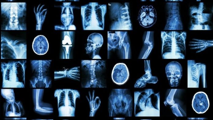 Oxford University Spin-out Begins Search for 10,000 X-rays to Help Predict Outcome for COVID-19