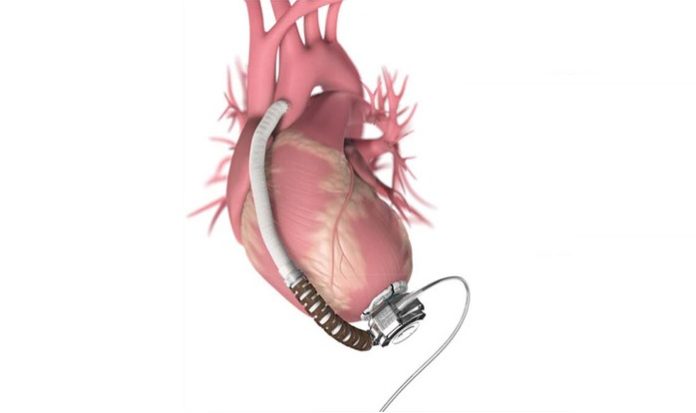 FDA Approves Abiomed's First-in-Human Trial of Impella ECP, World's Smallest Heart Pump