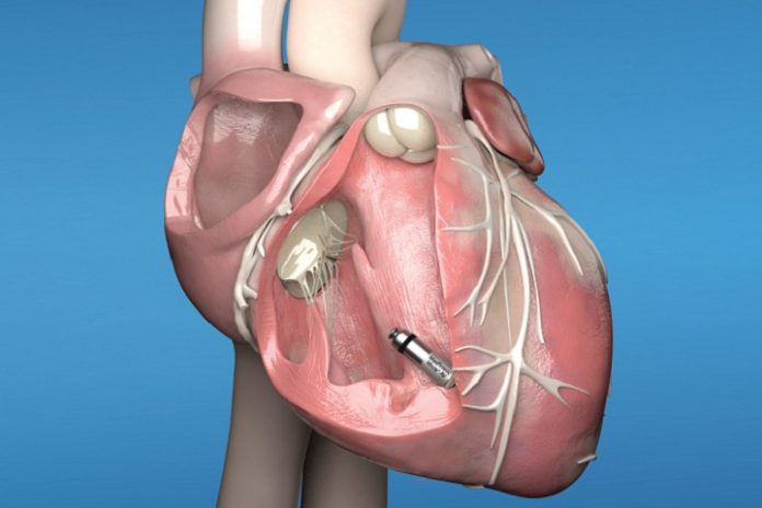 UK first - Glenfield Hospital implants the world's smallest leadless pacemaker into a patient's heart