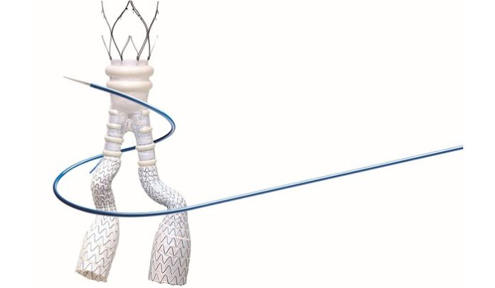 Endologix Launches ALTO Abdominal Stent Graft System in Europe
