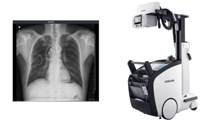 VUNO Inks Deal with Samsung Electronics to Embed AI-powered Algorithms in Samsungs Premium Mobile X-ray System