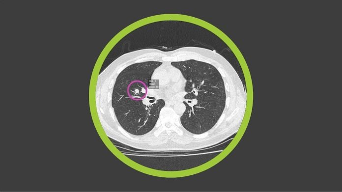 Optellum collaboration with the Lung Cancer Initiative at J&J, Applying AI to Transform Early Lung Cancer Treatment