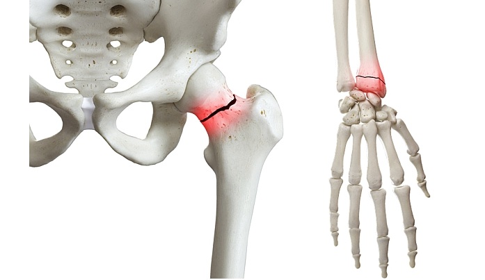 Launch of world-first expert resource to foster best practice osteoporosis care in the Asia Pacific