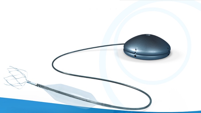 Aria CV Announces First Patient Successfully Implanted with Second-Generation Pulmonary Hypertension System